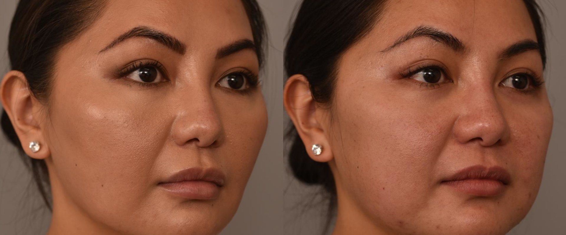 How Long Do the Results of Non-Surgical Fat Reduction Last?