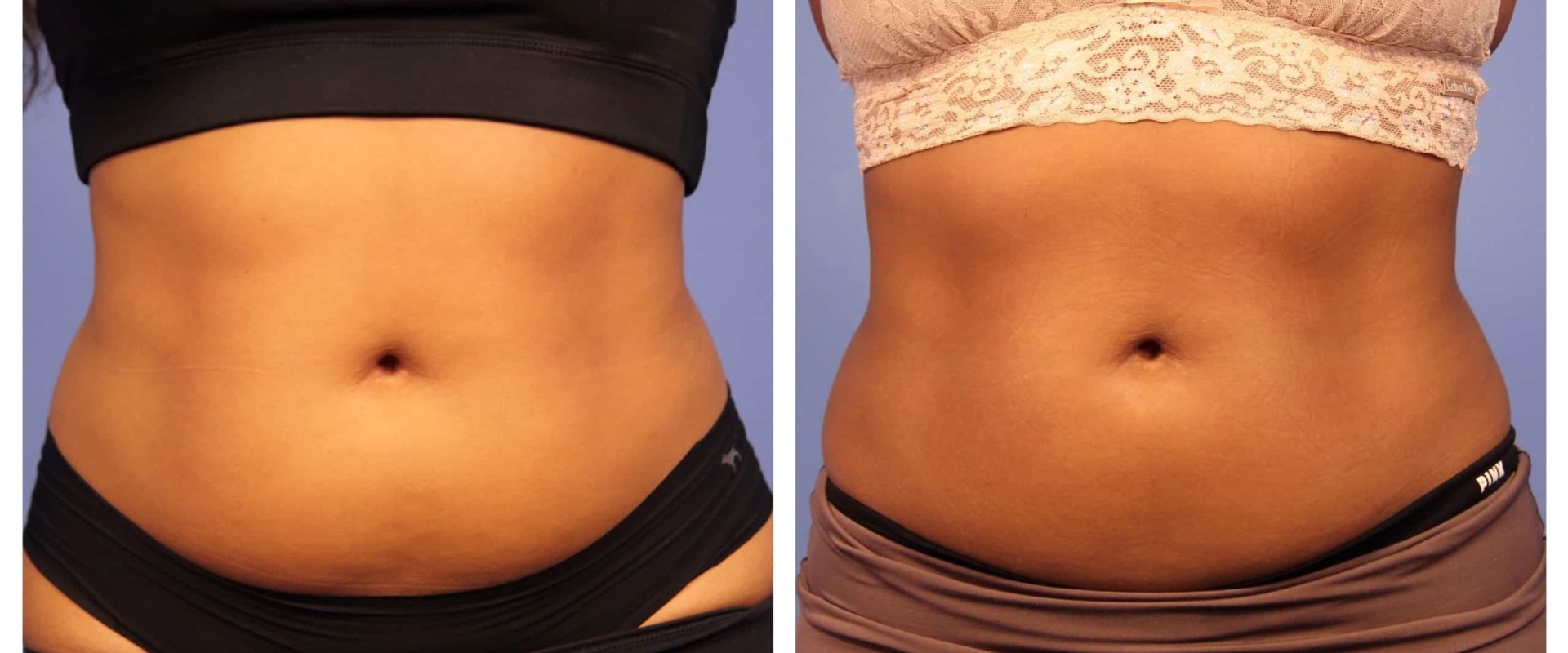 When Will I See Results from Non-Surgical Fat Reduction Treatment?