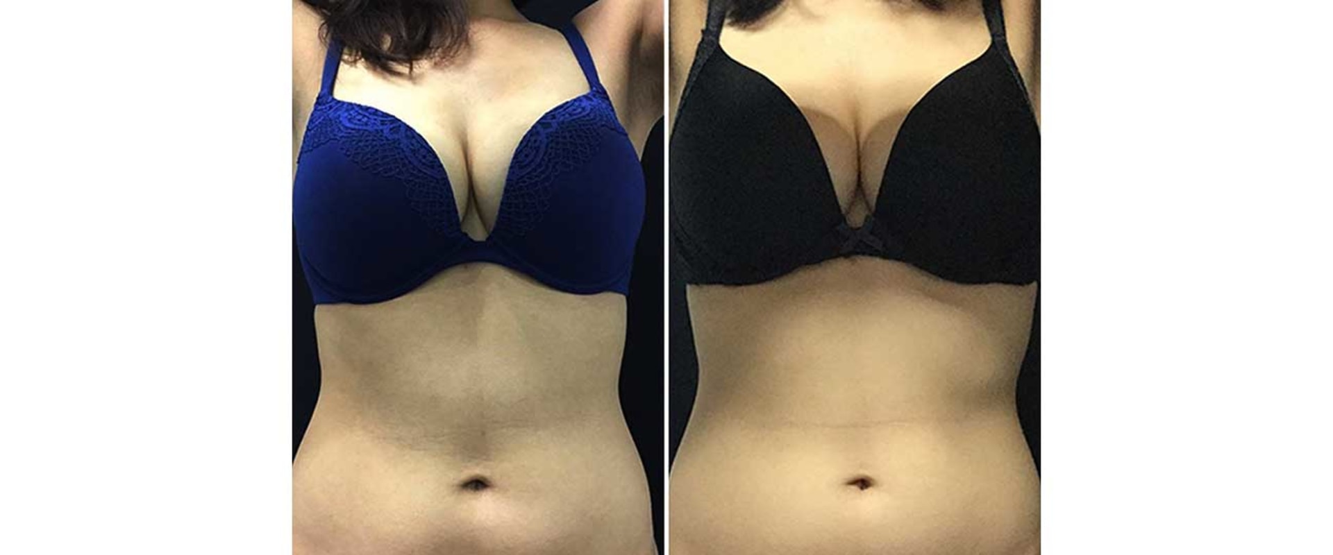 Non-Surgical Fat Reduction: How Much Does It Cost?