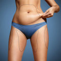 The Pros and Cons of Non-Invasive Fat Reduction