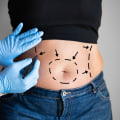 The Risks of Non-Surgical Fat Reduction