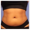 When Will I See Results from Non-Surgical Fat Reduction Treatment?