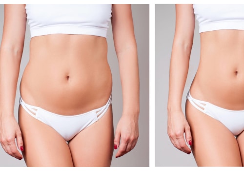 Achieve Peak Results: A Weight Loss Clinic Delivers The Best Nonsurgical Fat Reduction Solutions In Glendale