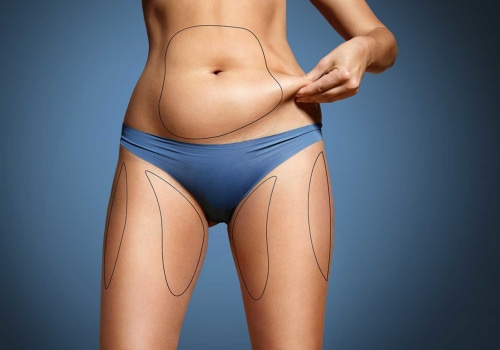 The Pros and Cons of Non-Invasive Fat Reduction
