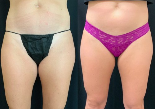 Liposuction In Scottsdale: A Nonsurgical Fat Reduction Option Worth Exploring
