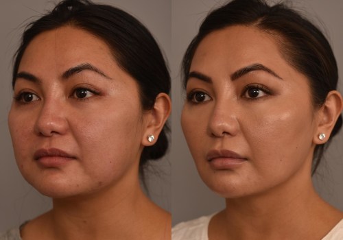 How Long Do the Results of Non-Surgical Fat Reduction Last?
