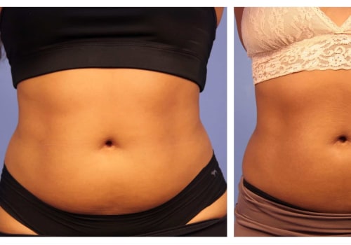 When Will I See Results from Non-Surgical Fat Reduction Treatment?