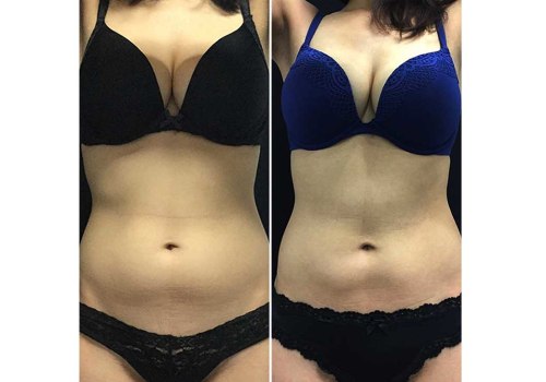 Non-Surgical Fat Reduction: How Much Does It Cost?
